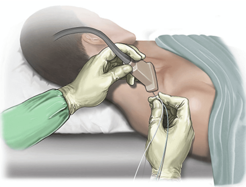 Peripheral Nerve Block Injections