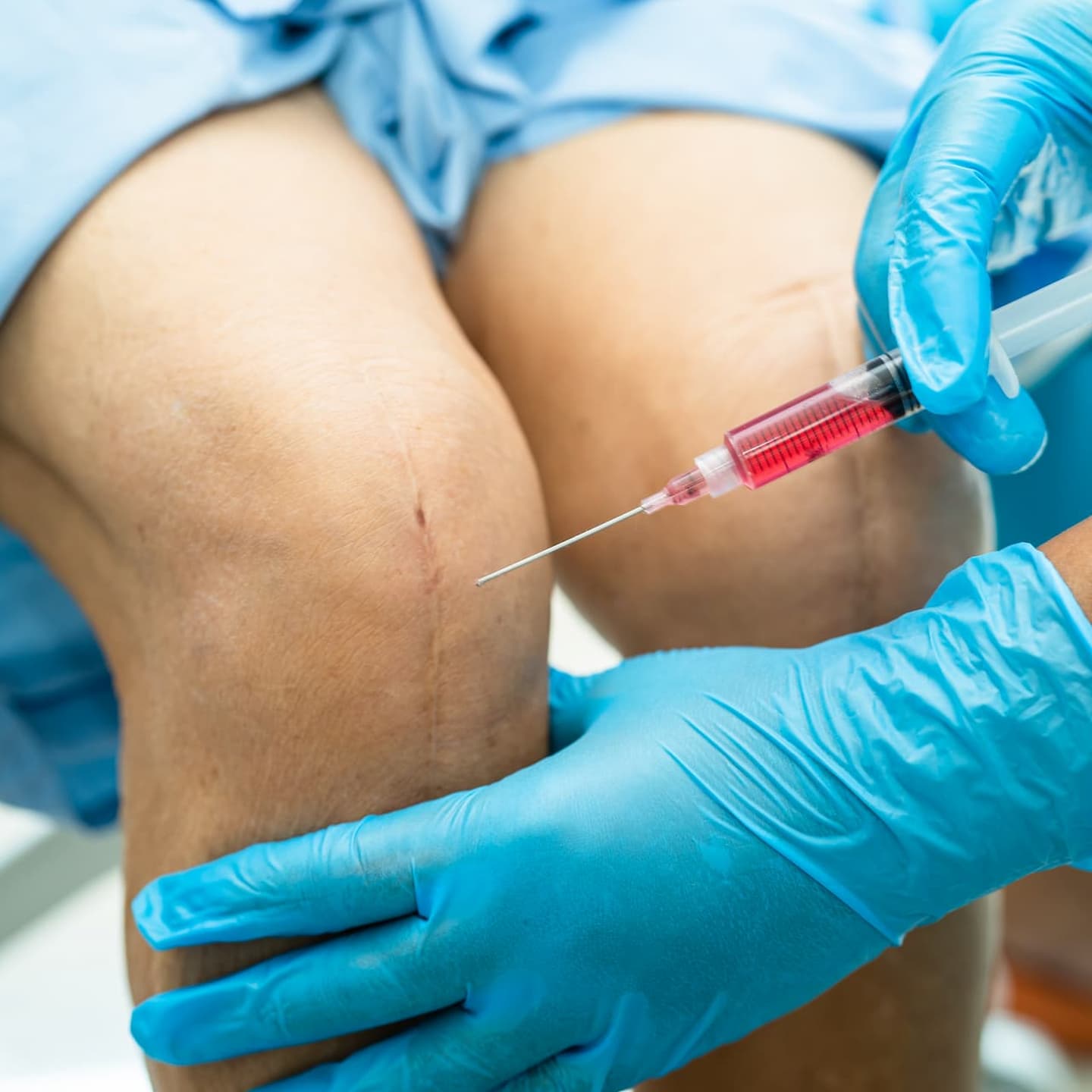 asian doctor inject hyaluronic acid platelet rich plasma into knee senior woman walk without pain 1 1 1 Interventional pain management treatments Interventional pain management treatments,regenerative medicine,stem cell treatment,Regenerative medicine in Hazlet NJ,interventional therapy near me